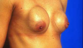 Nachher-Bild Brustvergrößerung