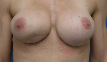 Vorher-Bild Brustvergrößerung