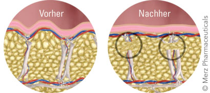 Anti-Cellutlite-Behandlung