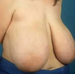 gigantomastie