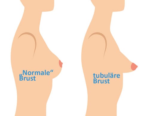 tubulaere-brust