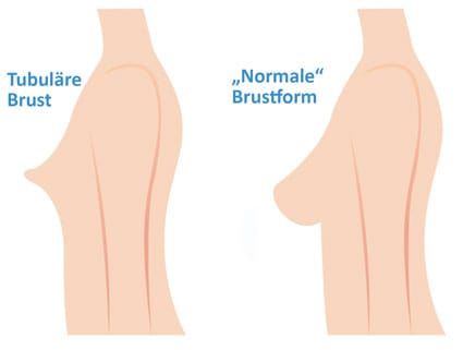 vergleich-normal-tubulaere-brust