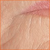 mentolabial_vorher_kl